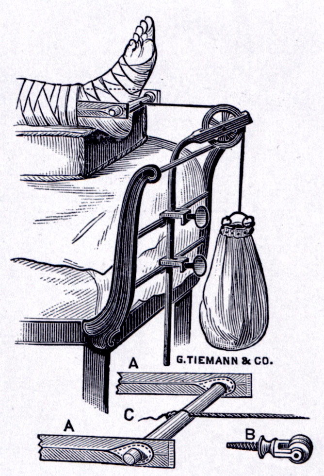 Sayre's Extension Sundries: "...consisting of two stout tapes, A, adjusted through button holes to the cross-piece, C. The ends of A are attached to the plaster secured to the limb, and C very nearly approaches the sole of the foot. To C is attached a strong cord, to run over the pulley B. To the end of the cord is to be attached a bag, as shown..." ["The American armamentarium chirurgicum" by George Tiemann & Co. McGovern Reference Collection, McGovern Historical]