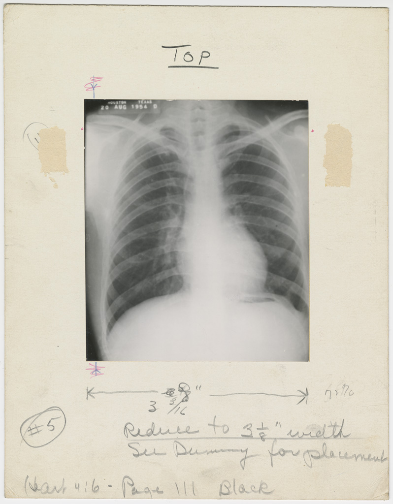 [Illustration, p. 111: “Pericardiectomy for Relief of Chronic Constrictive Pericarditis” X-ray image, November/December, 1955, Box 11, Folder 9, IC 094 Medical Arts Publishing Foundation, McGovern Historical Center, Texas Medical Center Library]